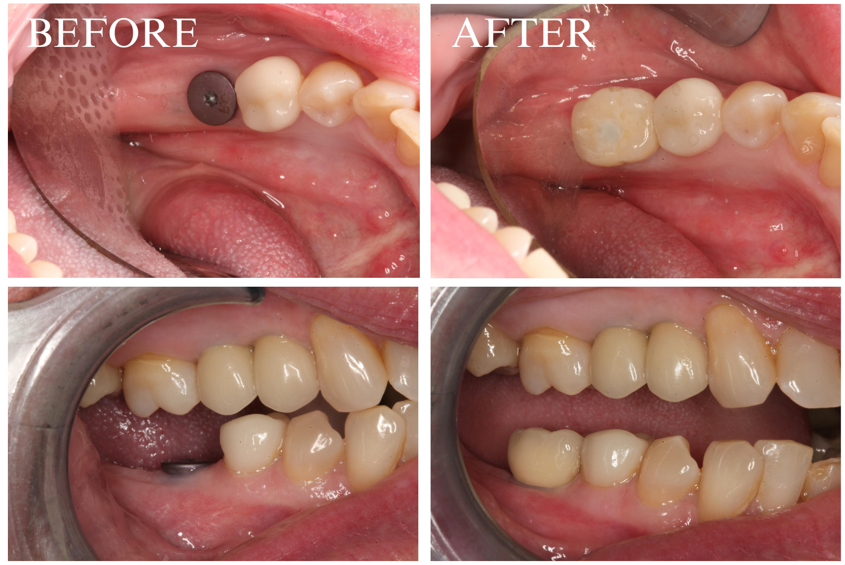 Implant Case 6