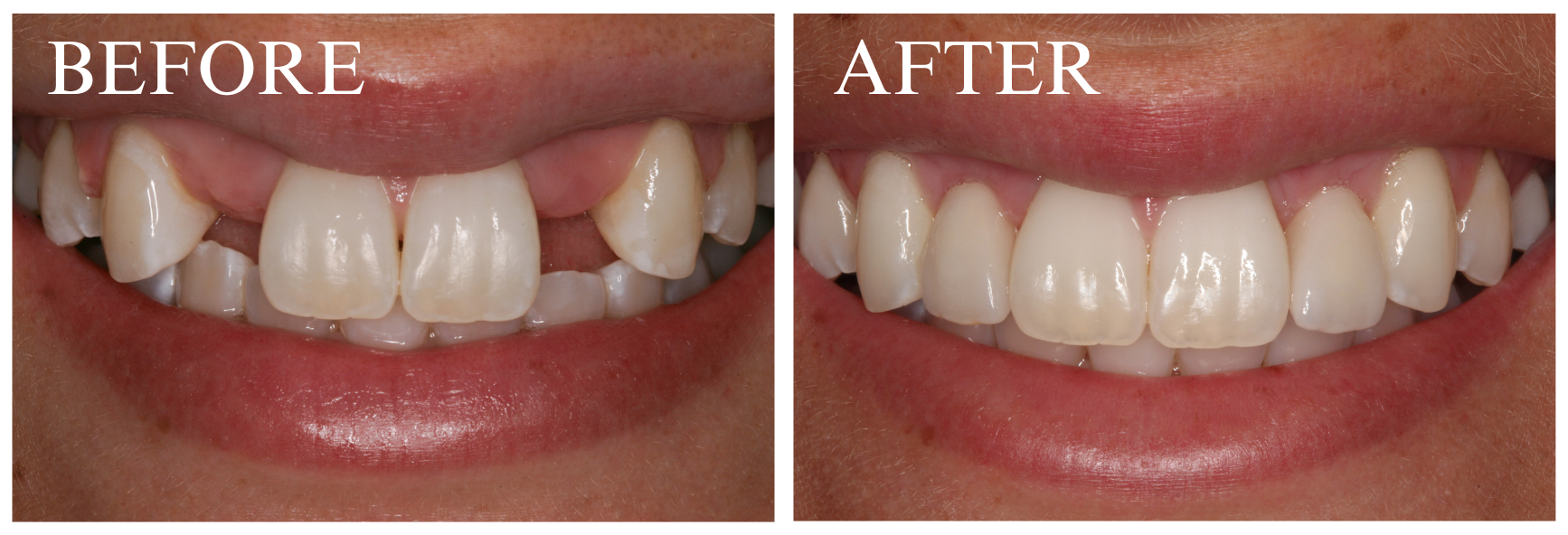 Implant Case 7