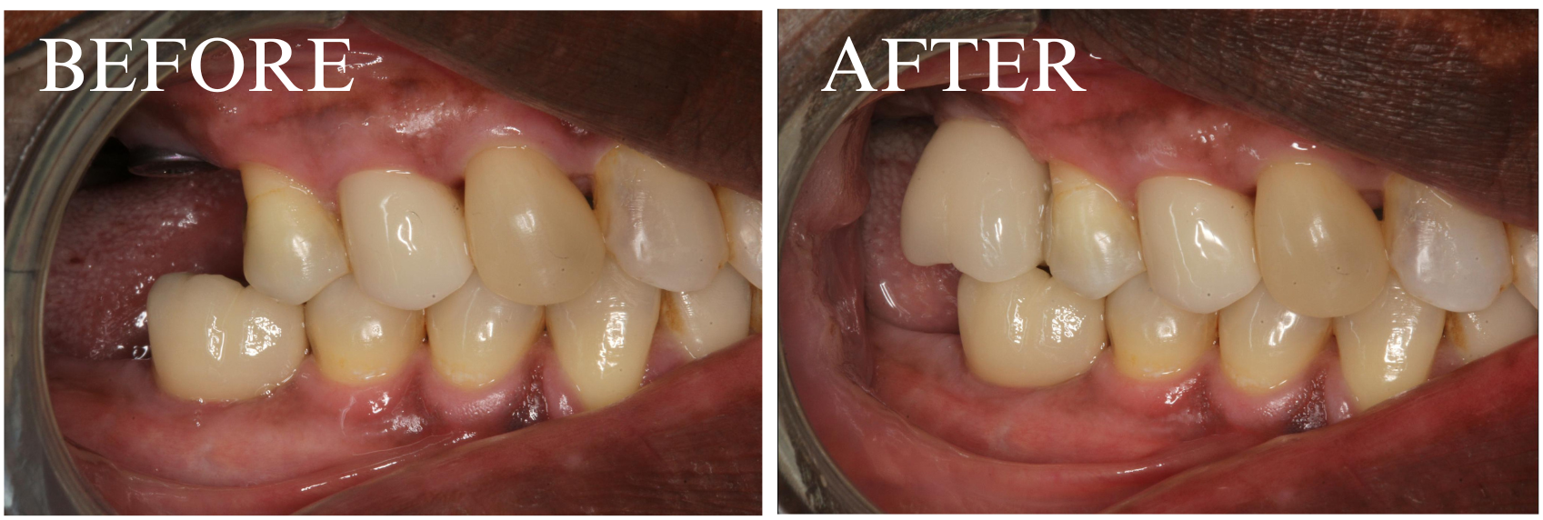 Implant Case 8