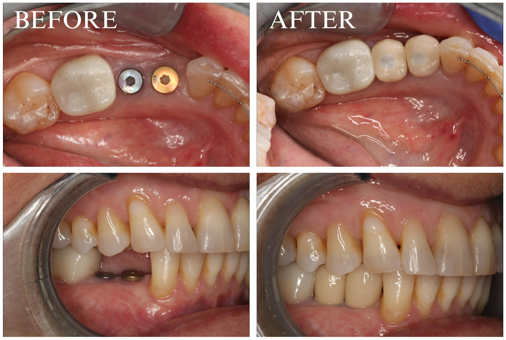 Implant Case 9