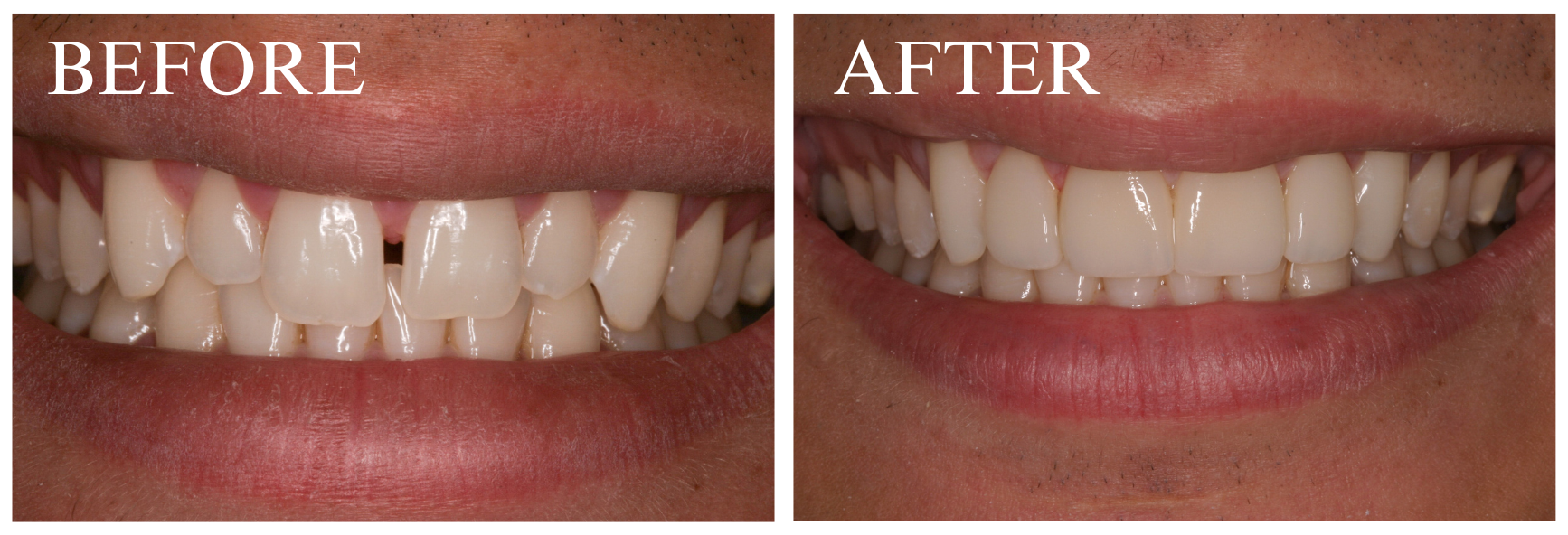 Veneer Case 2