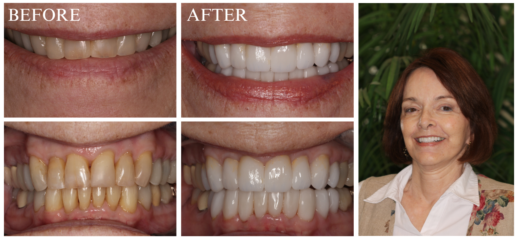 Veneer Case 4
