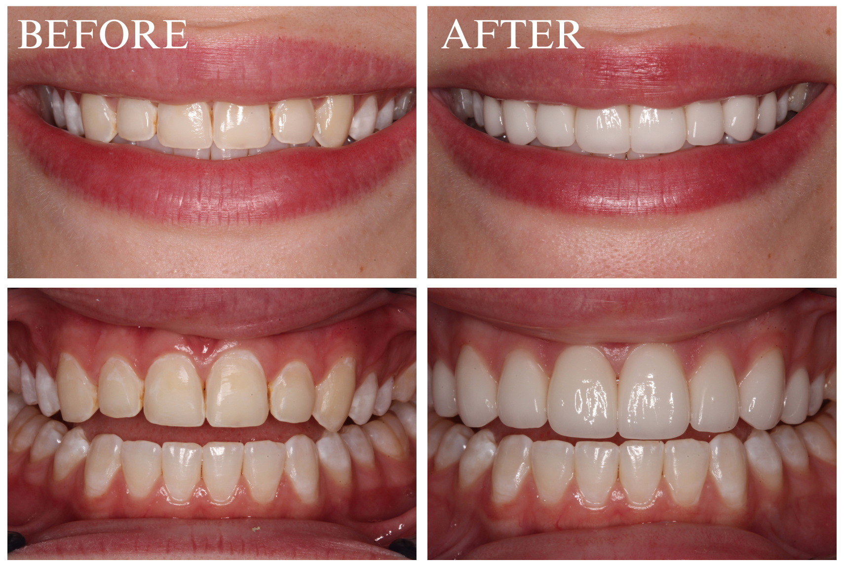 Veneer Case 7