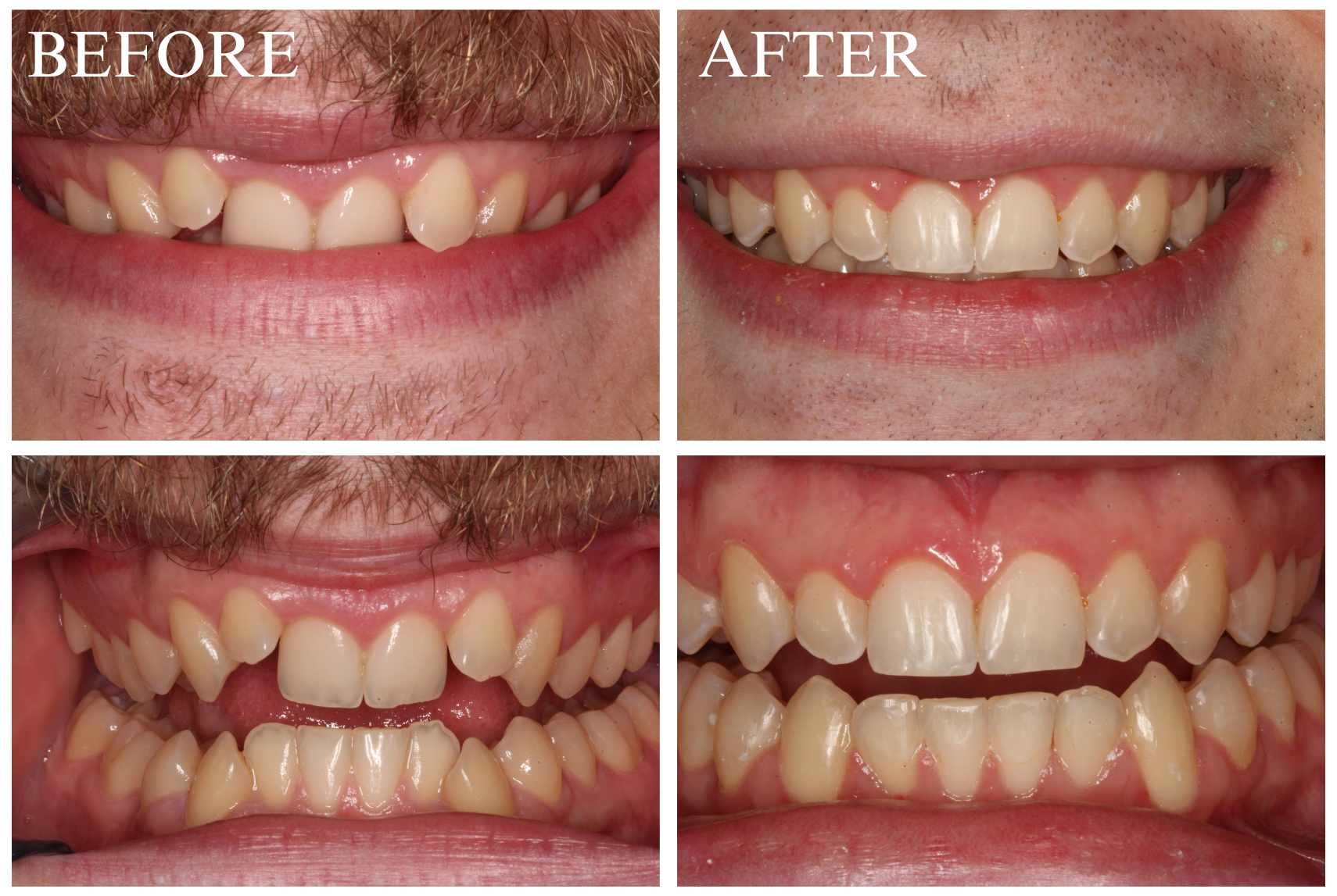 Braces Case 3_1