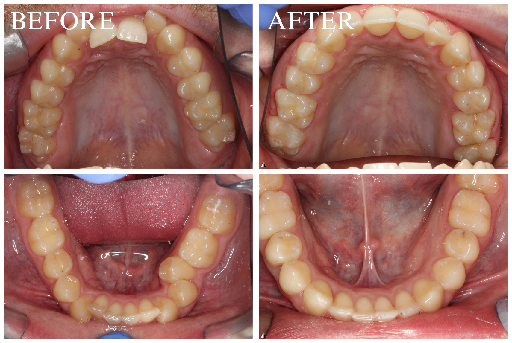 Braces Case 3_2