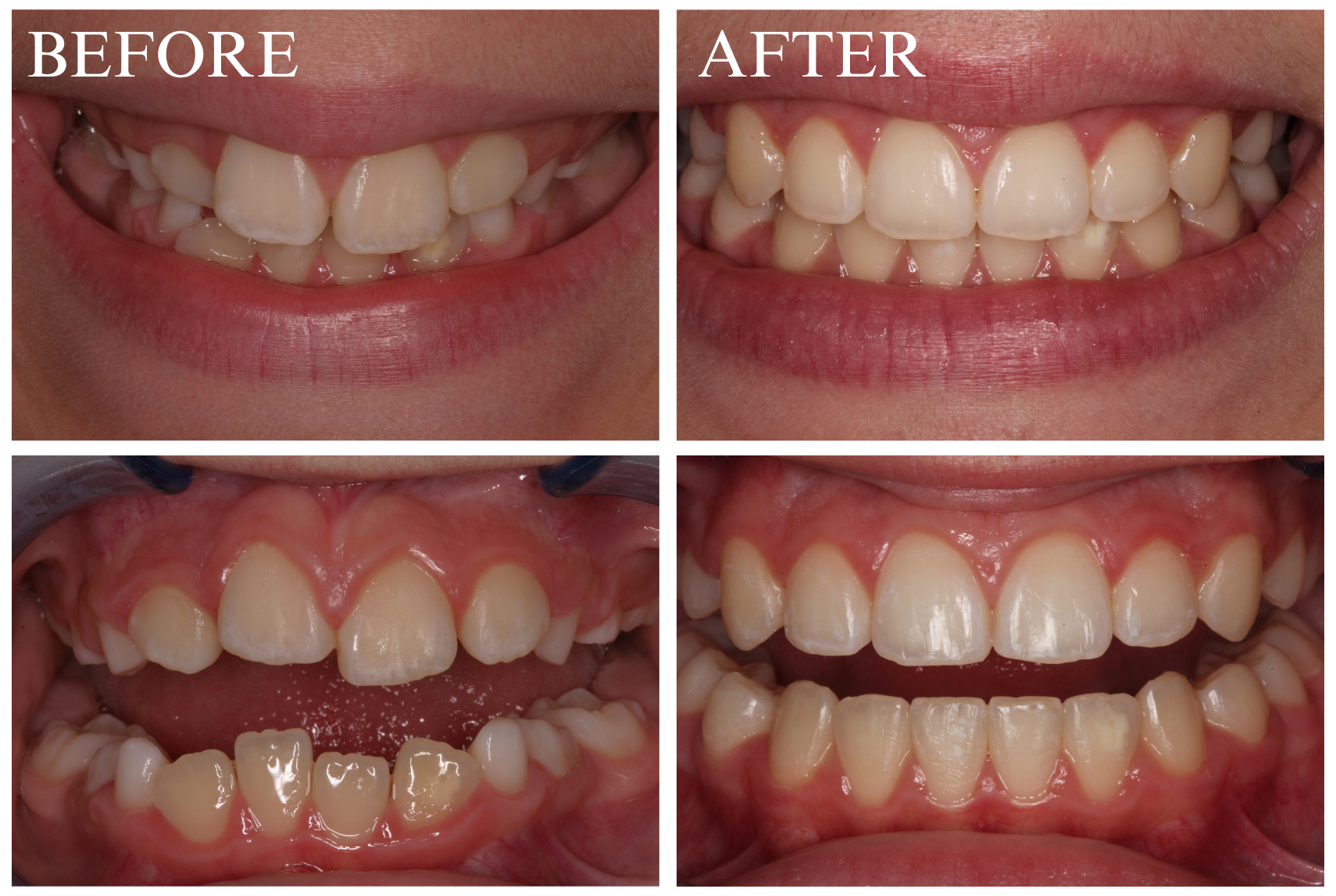 Braces Case 4