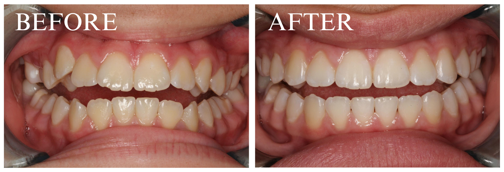 Braces Case 6_1