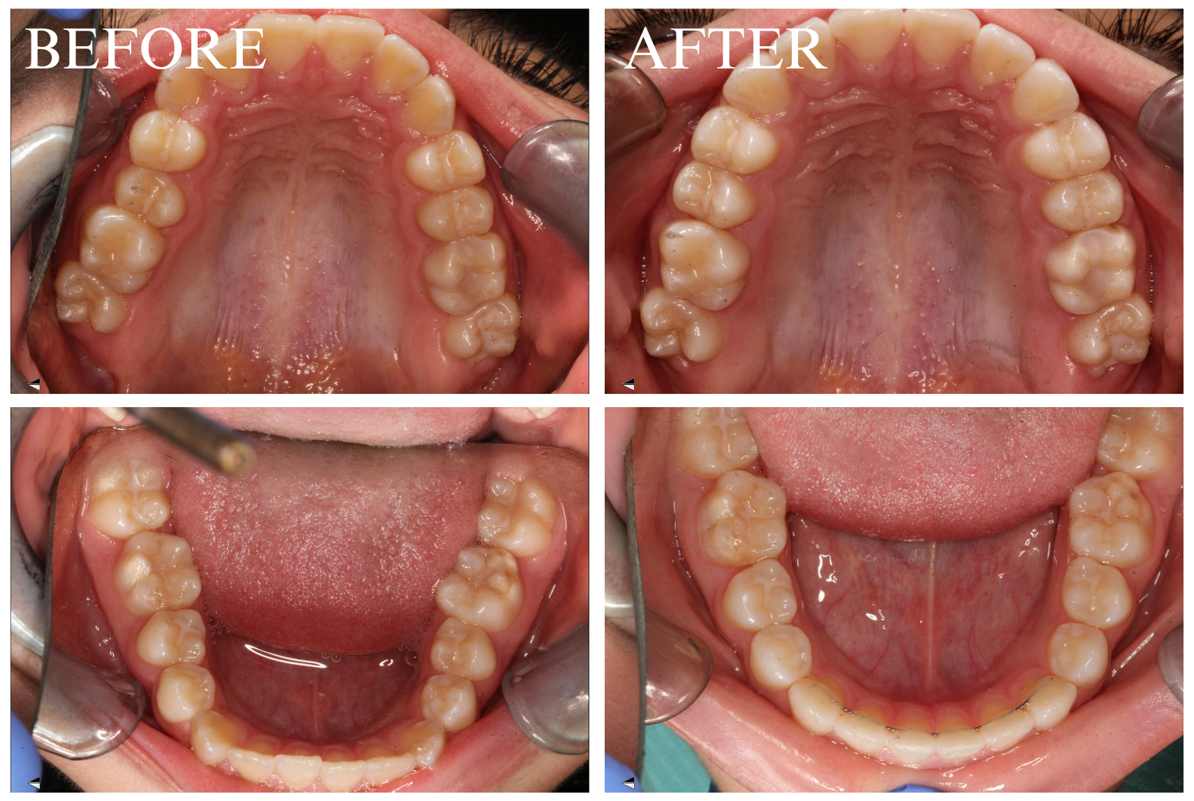 Braces Case 6_2