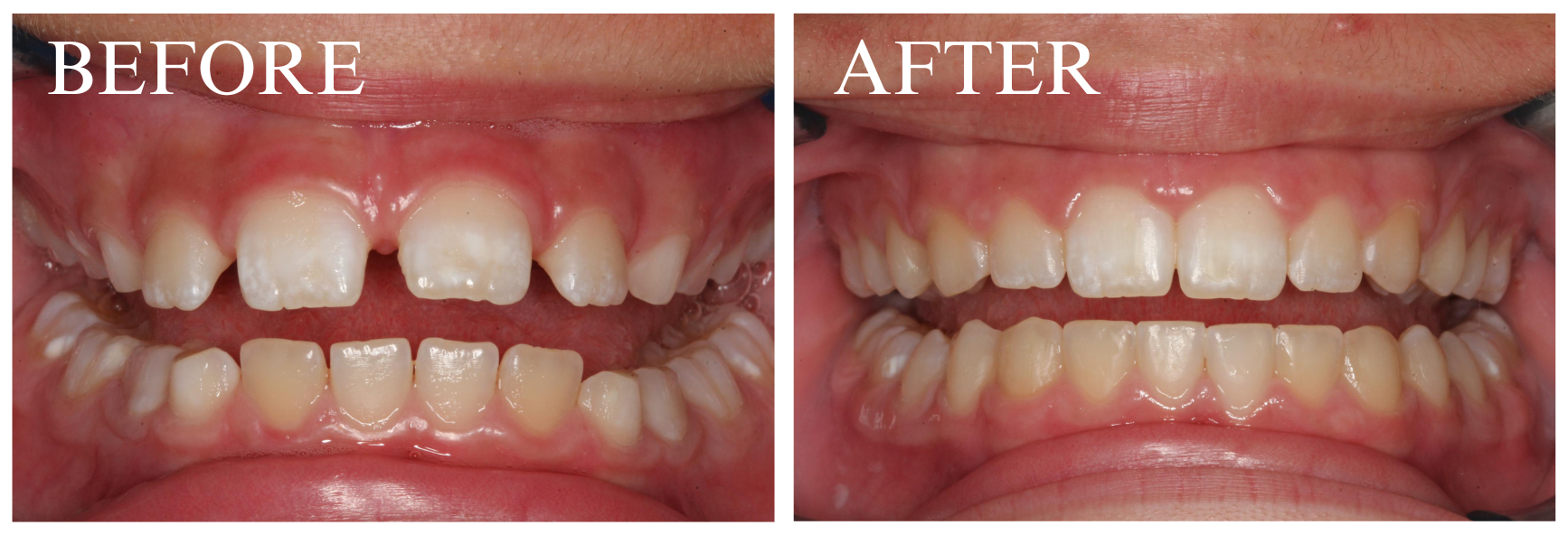 Braces Case 8