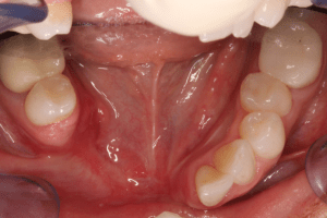 Oral cancer examination
