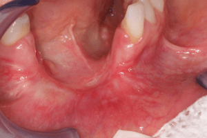 Oral cancer examination